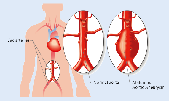 Abdominal Aortic Aneurysm