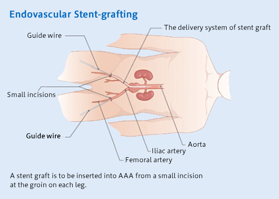 Endovascular Stent-grafting