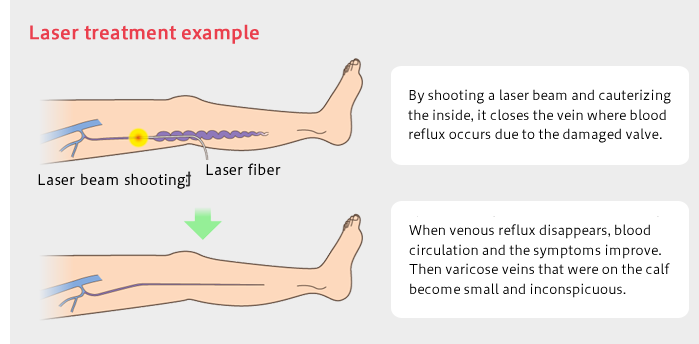 Laser treatment example