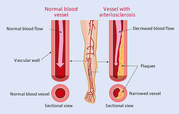 Arteriosclerosis Obliterans