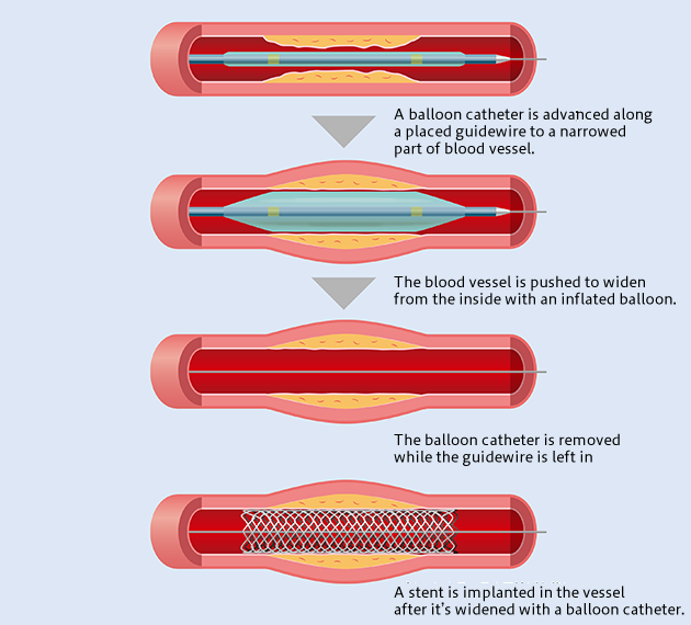 Endovascular Treatment for Arteriosclerosis Obliterans