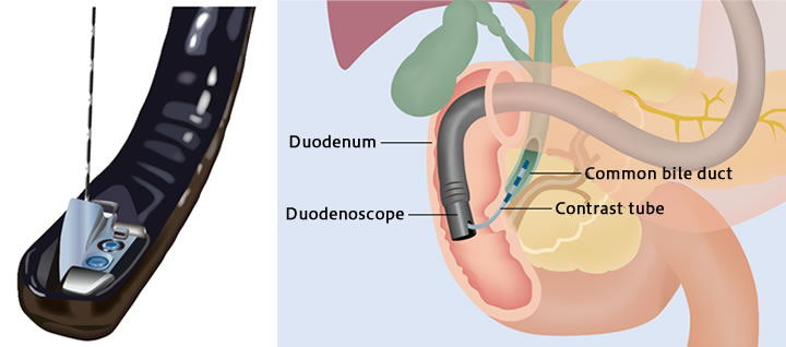 Approach to the biliary/pancreatic duct with a side-viewing endoscope