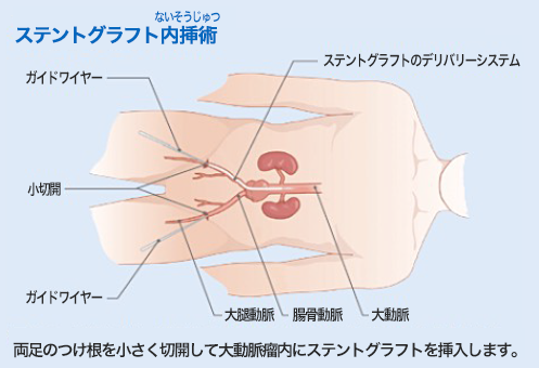 ステントグラフト内挿術