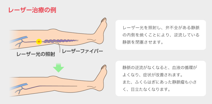 レーザー治療の例